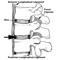 Anterior Lumbar Interbody Fusion (ALIF)