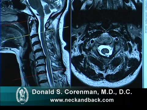 Understanding the MRI of Cervical Stenosis with Spinal Cord Injury