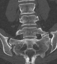 Transverse Alar Articulation