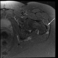 Greater Trochanteric Bursitis MRI