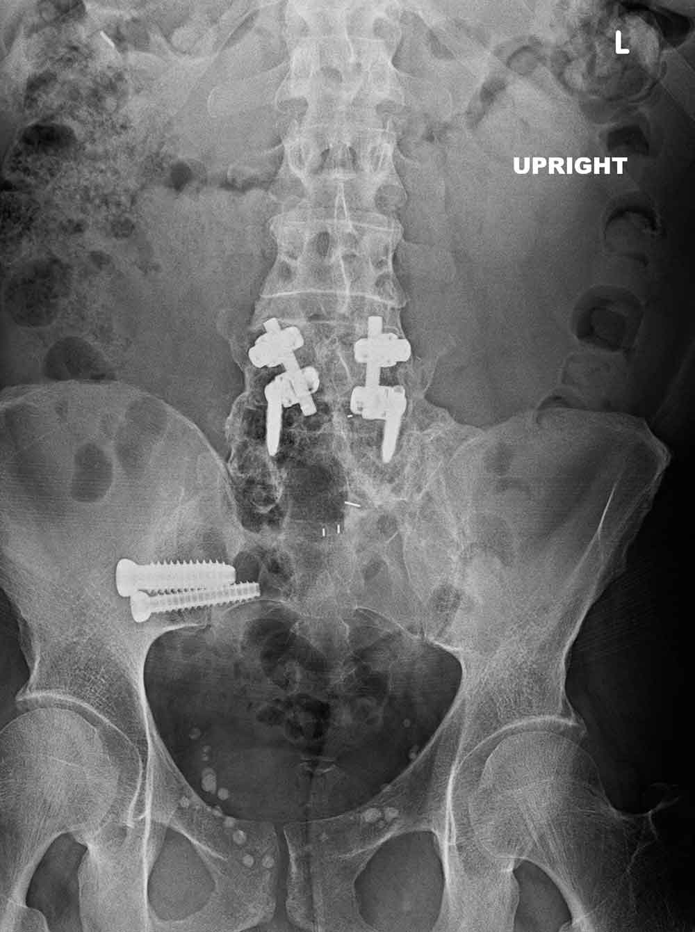 Sacroiliac Fusion