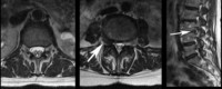Far Lateral Lumbar Disc Herniation MRI's