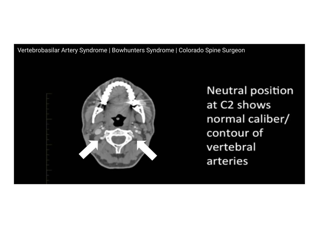 Colorado Health Insurance >> Vertebrobasilar Artery Syndrome | Vertebrobasilar Artery ... Colorado Health Insurance >> Vertebrobasilar Artery Syndrome | Vertebrobasilar Artery ...